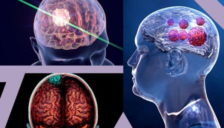 brain-tumer