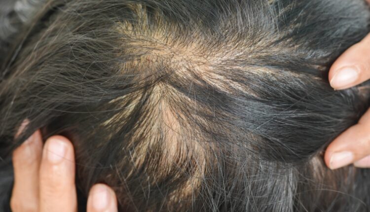 Alopecia