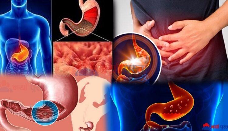 ulcer